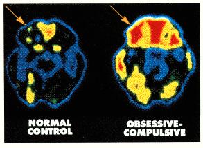 PET scan shows hyperactivity in OCD but Obsessive Compulsive Disorder Treatments change the game.