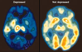 Lithium: Old drug lights path to new hope for bipolar disorder.